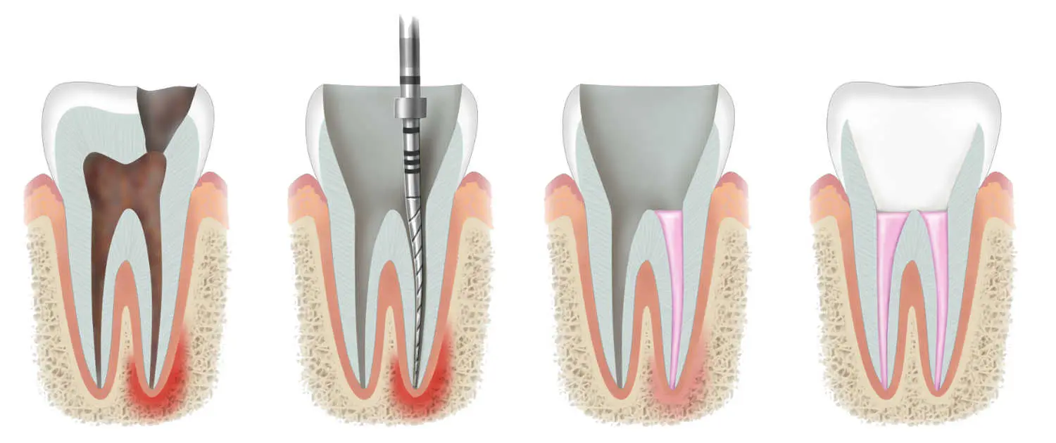 Fillings Root Canals