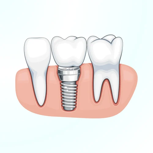Surgery Implants