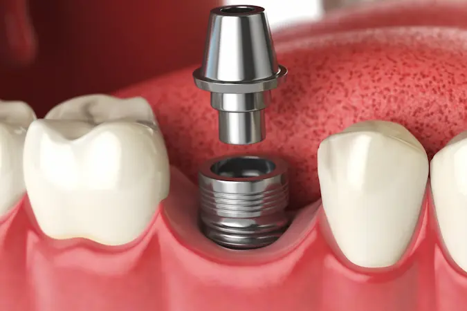 Surgery & Dental Implants